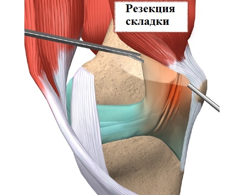 Резекция медиопателлярной складки