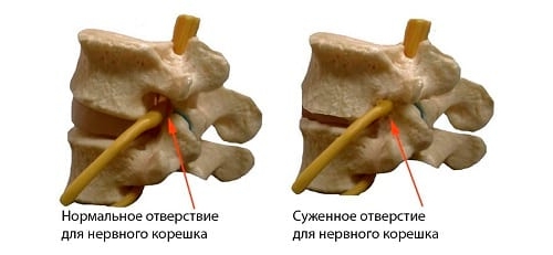 Сдавливание нервного корешка