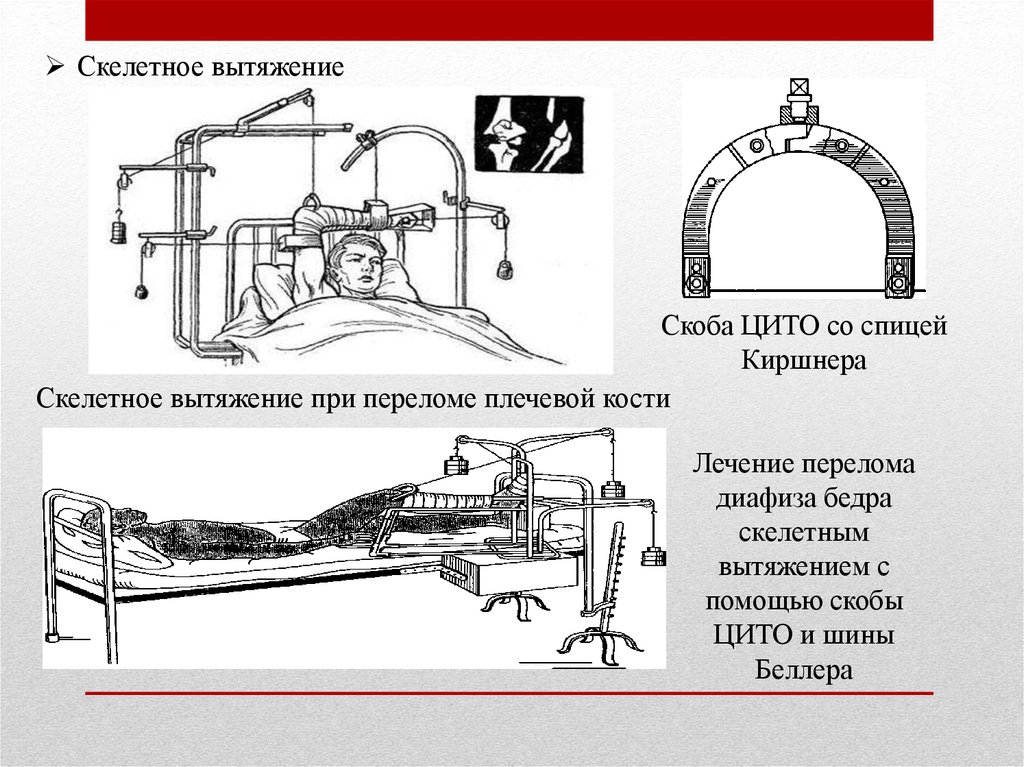 Скелетное вытяжение с металлическими конструкциями