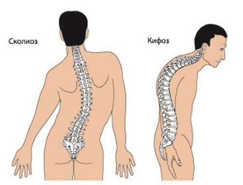 Сколиоз и кифоз Сколиоз и кифоз
