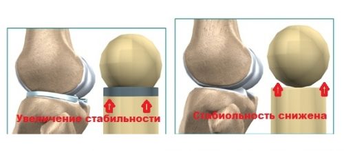 Снижение стабильности при отсутствии мениска