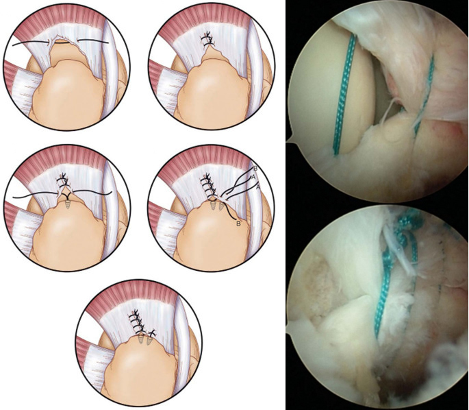 Сшивание манжеты плечевого сустава Сшивание манжеты плечевого сустава
