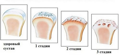 Стадии артроза