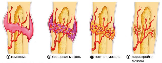 Стадии сращивания кости