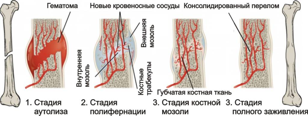 Стадии срастания кости после перелома