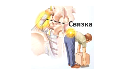 Повреждение связки внизу спины Повреждение связки внизу спины