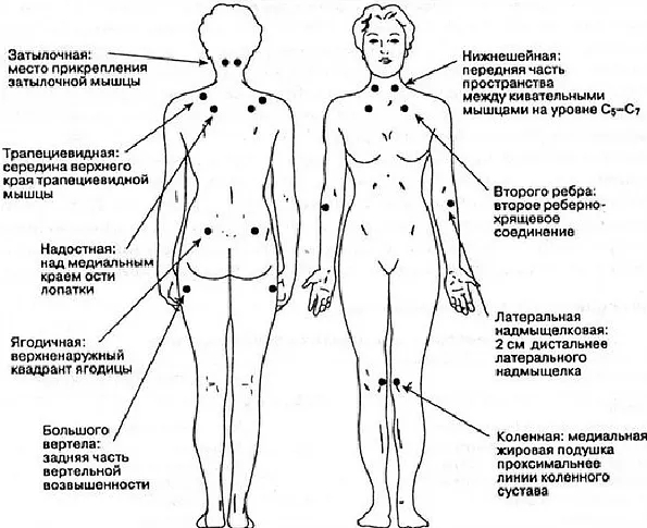 Триггерные точки фибромиалгии Триггерные точки фибромиалгии