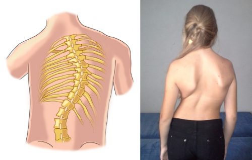 Тяжелая степень сколиоза Тяжелая степень сколиоза
