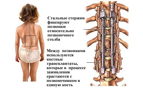 Установка стальных стержней Установка стальных стержней