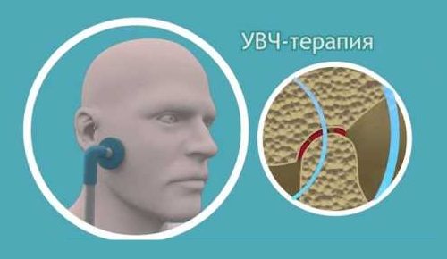 УВЧ терапия челюстного сустава УВЧ терапия челюстного сустава
