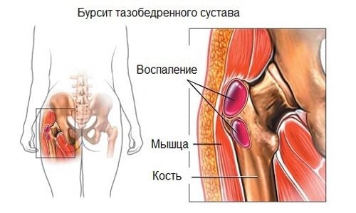 Вертельный бурсит