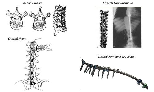Методы оперативного лечения сколиоза Методы оперативного лечения сколиоза