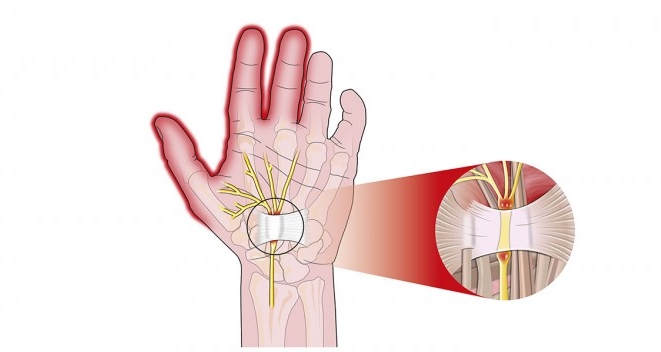 Защемление лучевого нерва Защемление лучевого нерва