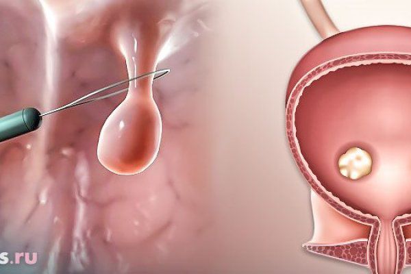 Полипэктомия