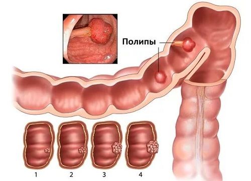 Полипоз