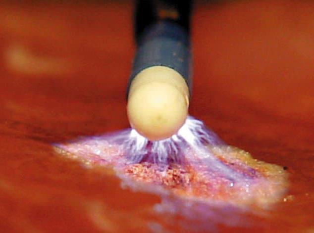 Прижигание образований