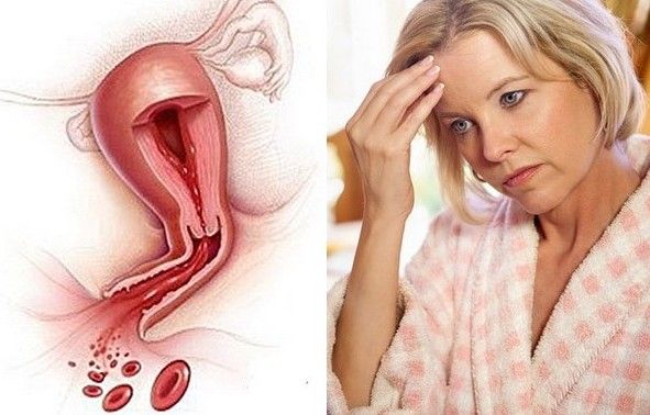 Кровотечение