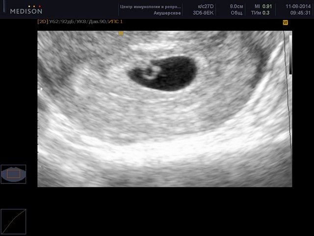 Снимок УЗИ при беременности
