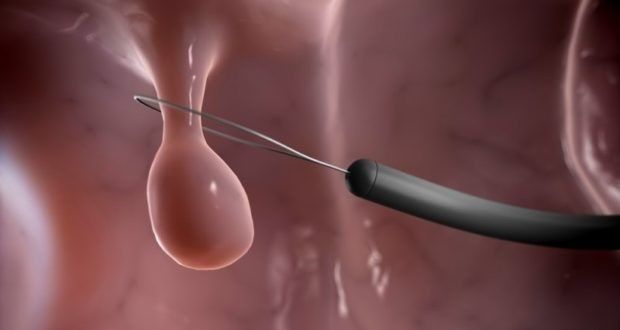 Полипэктомия полипа матки