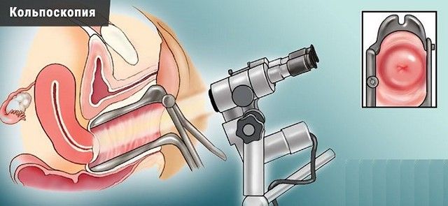 Кольпоскопия при полипе