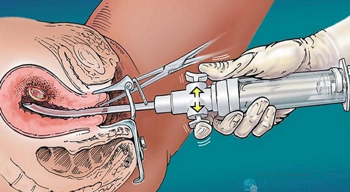 Метод вакуум-аспирация