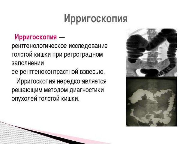 Ирригоскопия