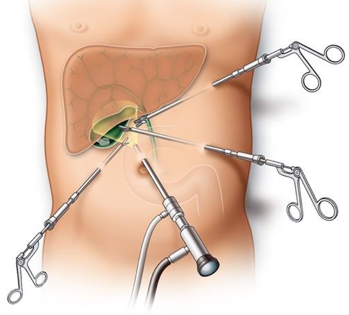 Лапароскопия желчного пузыря