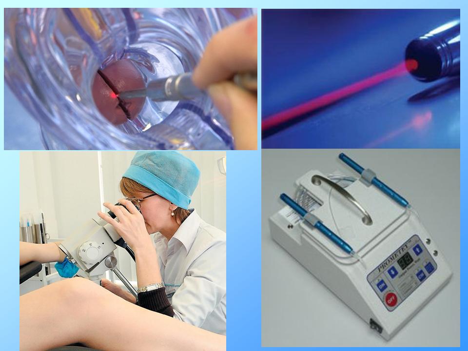 Лазерная коагуляция