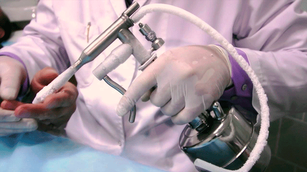 Криодеструкция