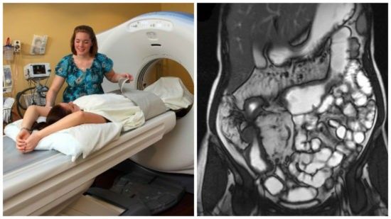 МРТ Кишечника