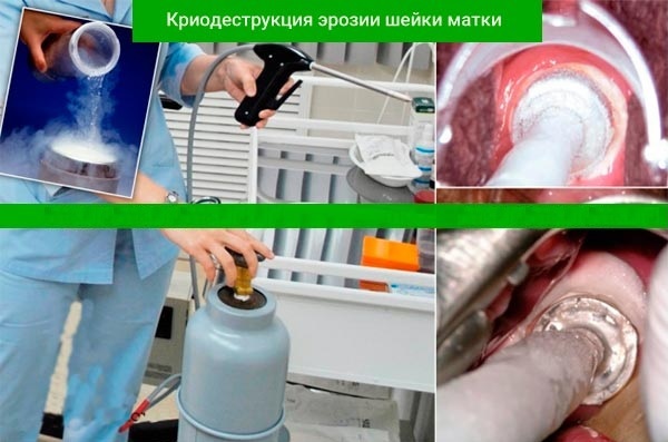 Криодеструкция