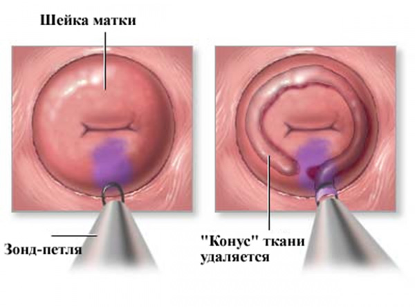 Электрокоагуляция шейки матки