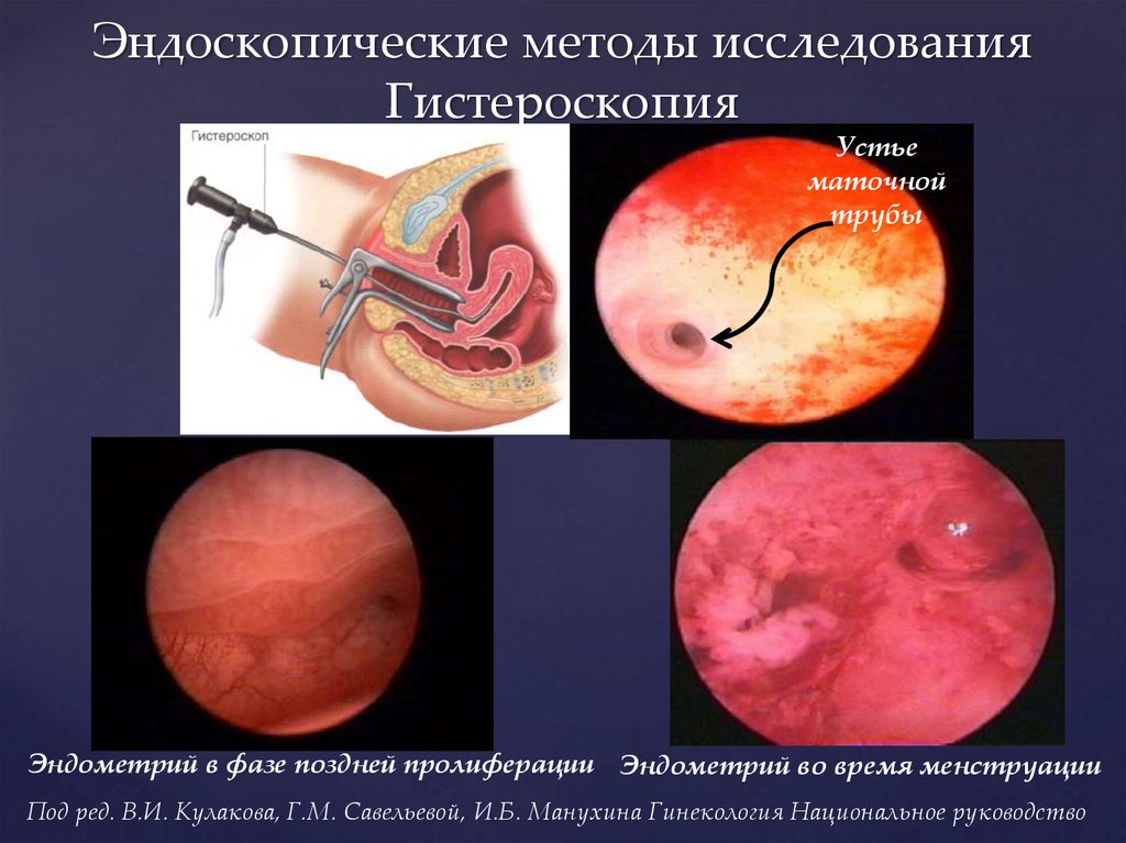 Эндоскопическое исследование матки