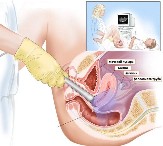 Вагинальное УЗИ