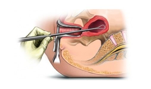Удаление выскабливанием