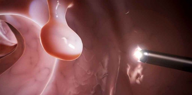 Лазерное удаление