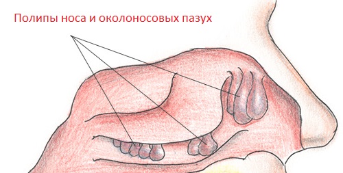 Полипы в носу Полипы в носу