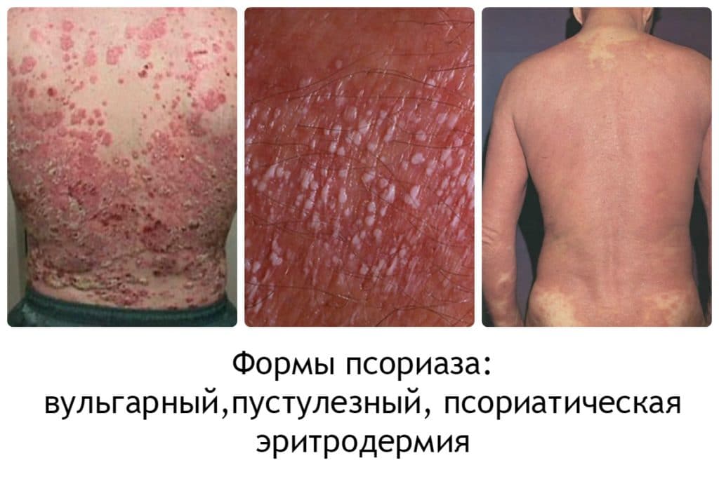 Формы псориаза