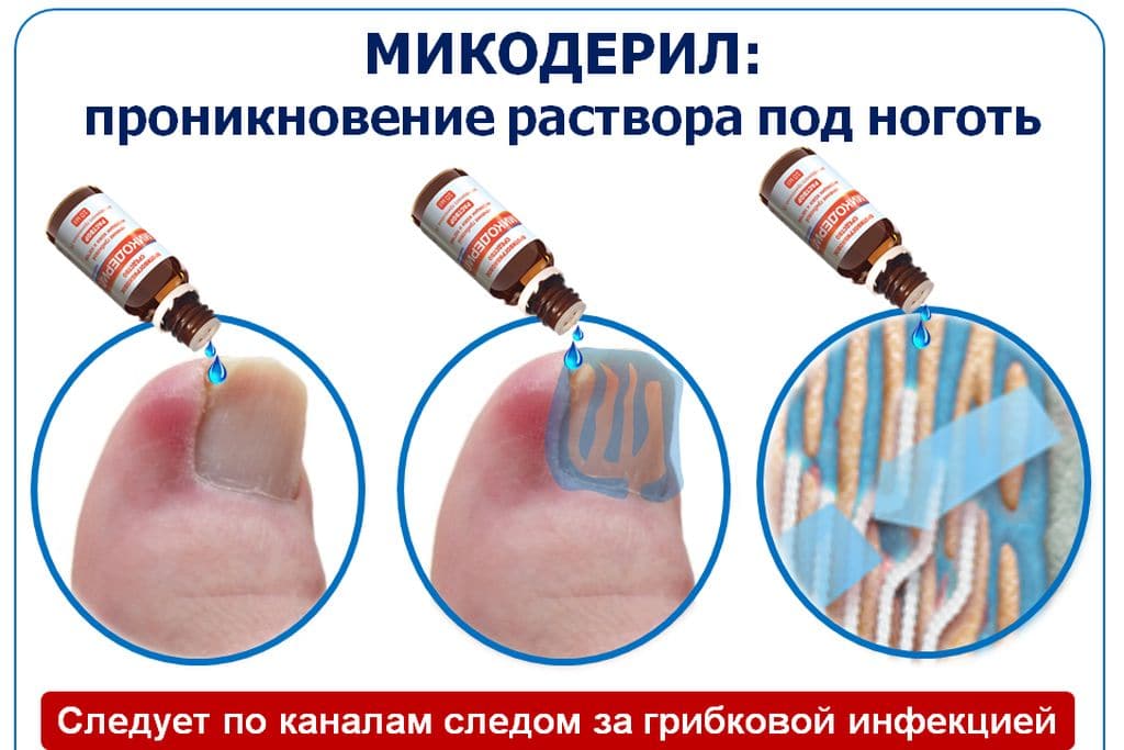 Раствор Микодерил Раствор Микодерил