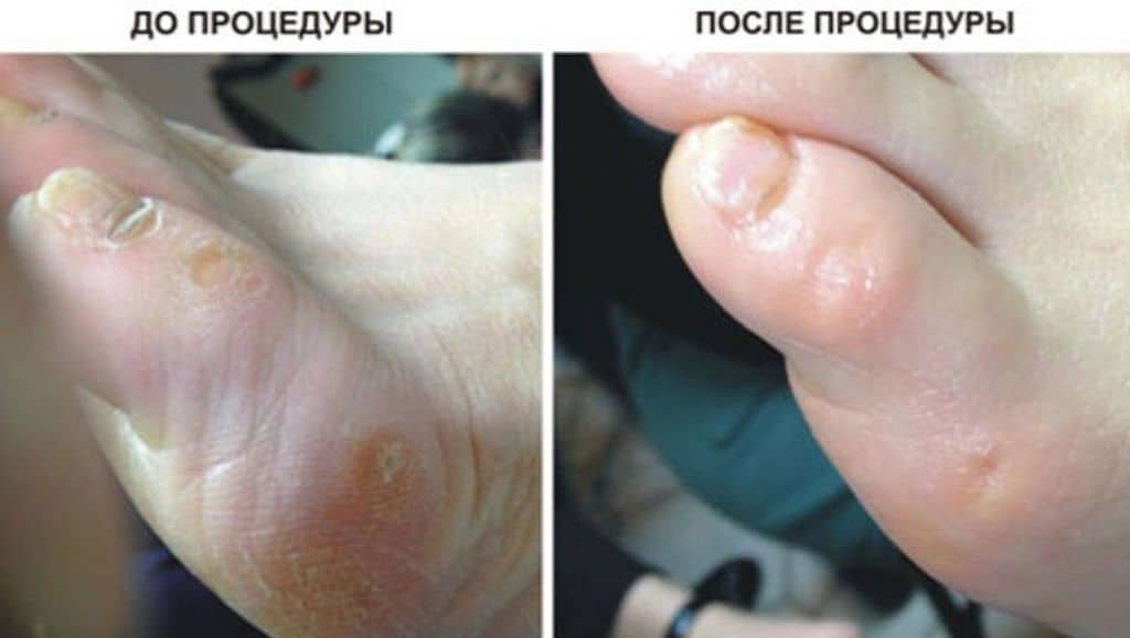 Польза медицинского педикюра при грибке Польза медицинского педикюра при грибке