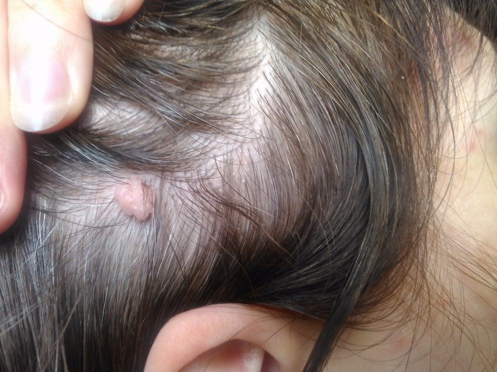 Виды и причины появления бородавок на голове Виды и причины появления бородавок на голове