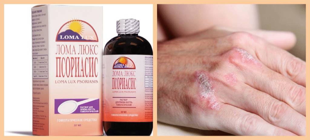 Лома Люкс при псориазе Лома Люкс при псориазе