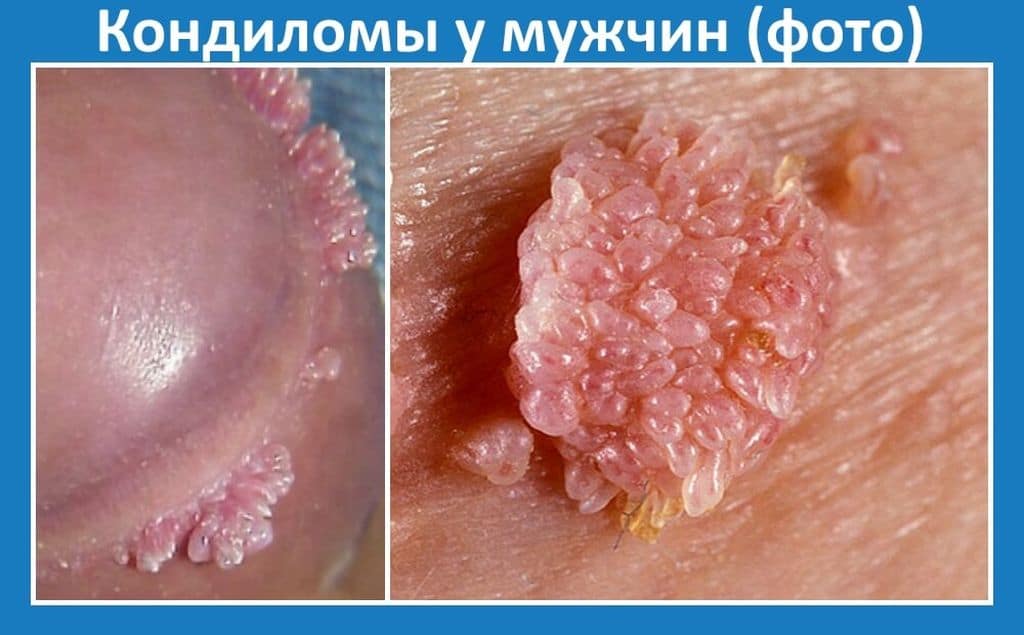Папилломы у мужчин Папилломы у мужчин
