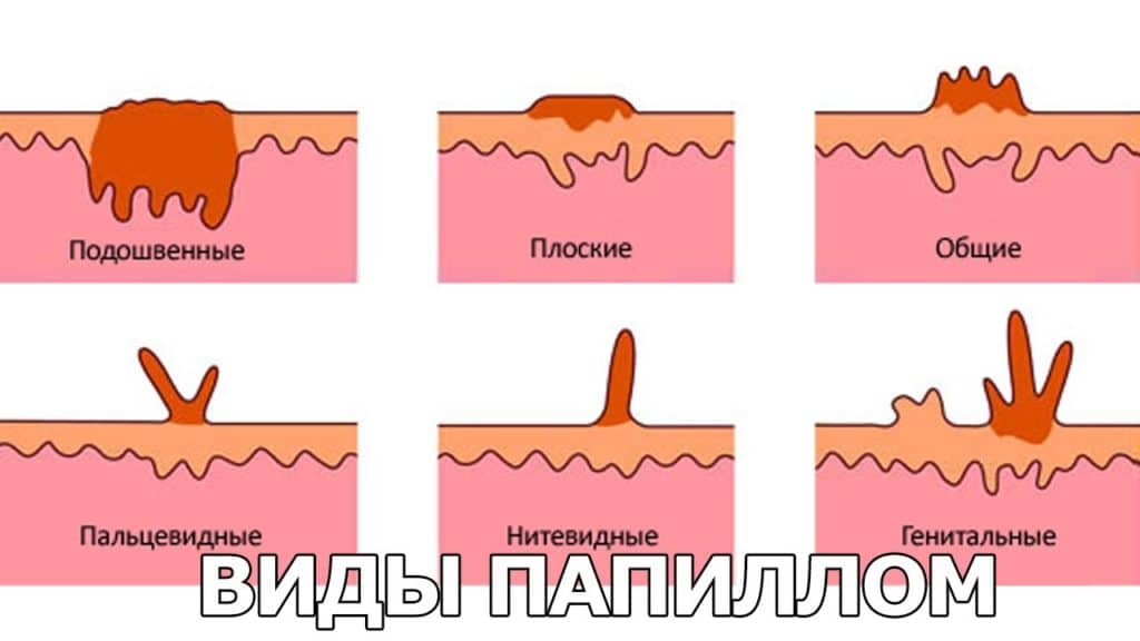 Виды папиллом Виды папиллом