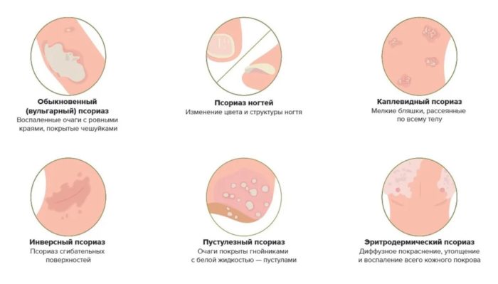 Какие анализы сдавать при псориазе
