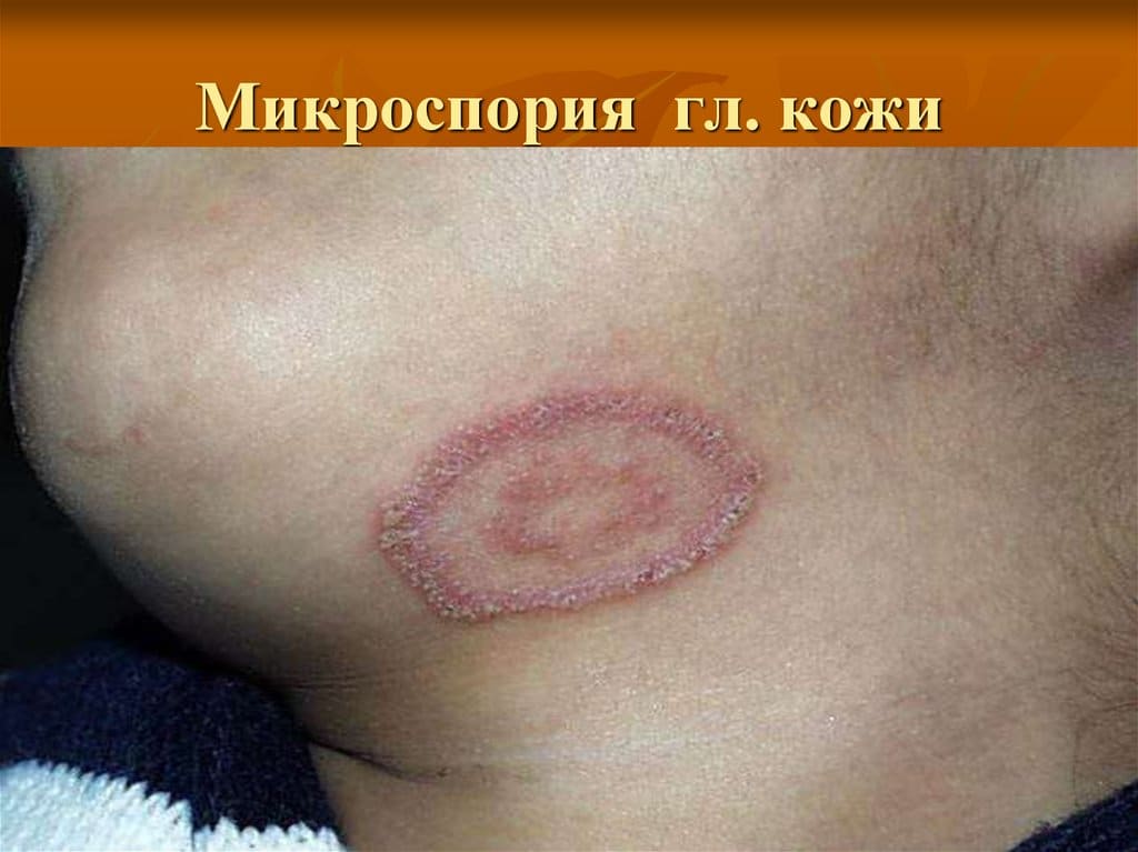 Микроспория гладкой кожи Микроспория гладкой кожи
