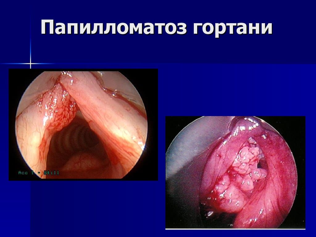 Папилломатоз гортани Папилломатоз гортани