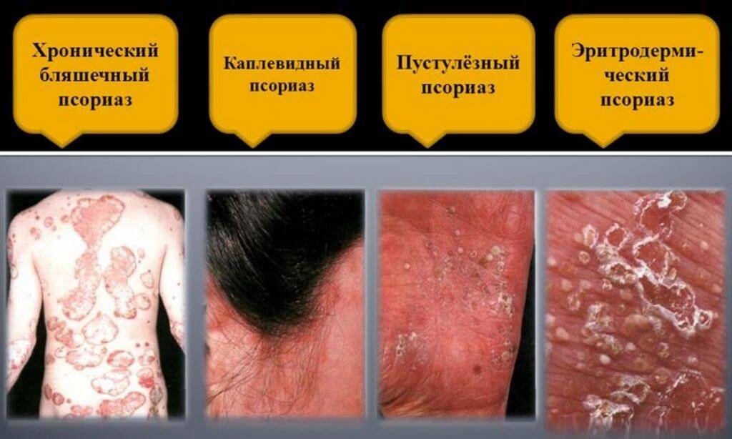 Типы псориаза Типы псориаза